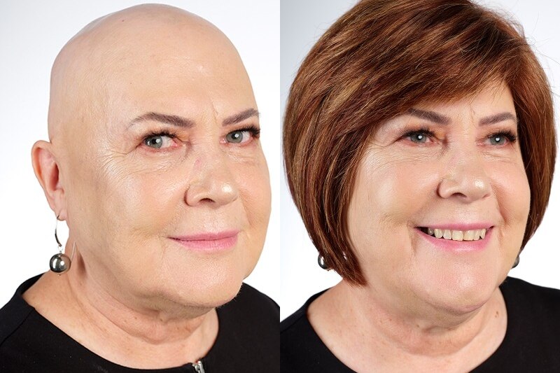 Alopecia awareness advocate Liz Beat with and without her wig.