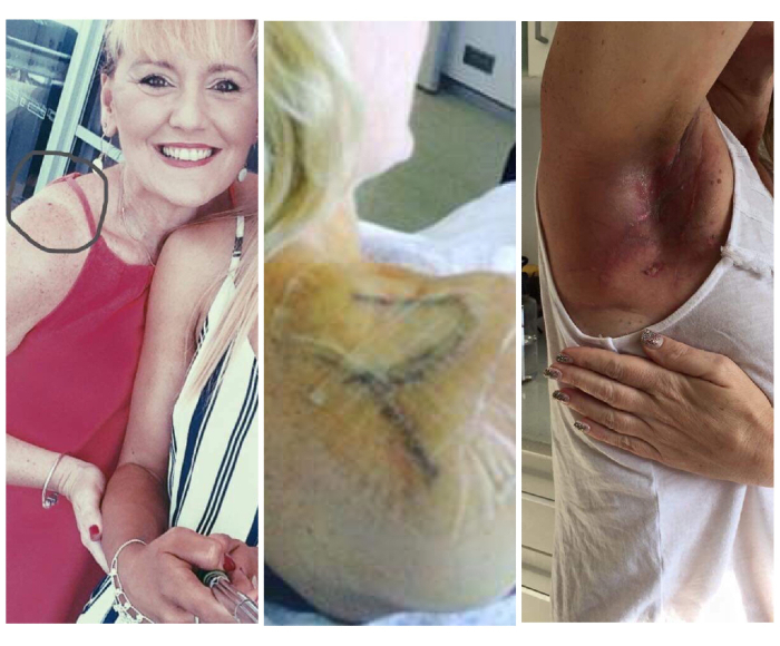 Collage of a melanoma on a woman's shoulder, the removal scar, and lymph node scar under her arm