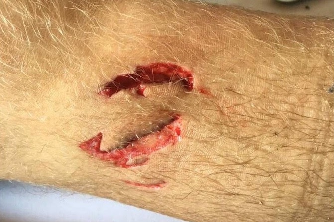 A bite mark on 17-year-old Sean Whitcombe's leg.