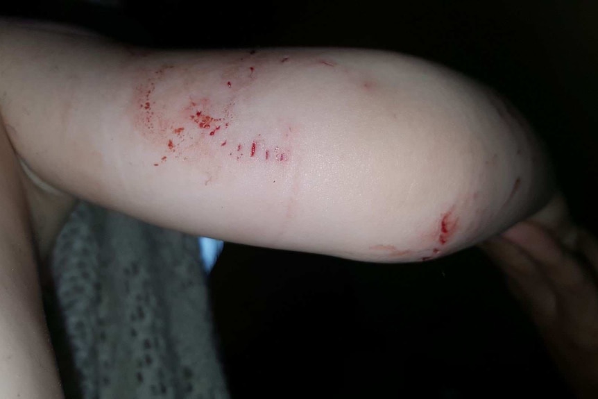 Toddler Naish Dobson's arm after showing bites by a large scrub python at his home at Julatten.