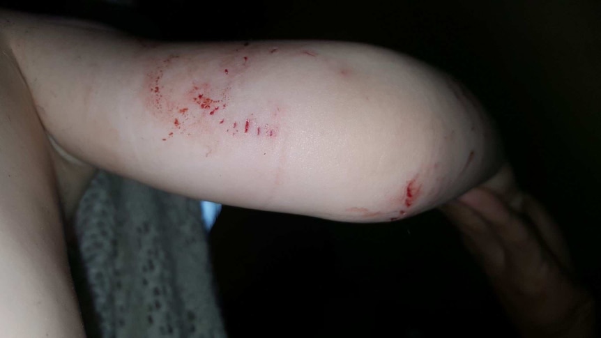 Toddler Naish Dobson's arm after showing bites by a large scrub python at his home at Julatten.
