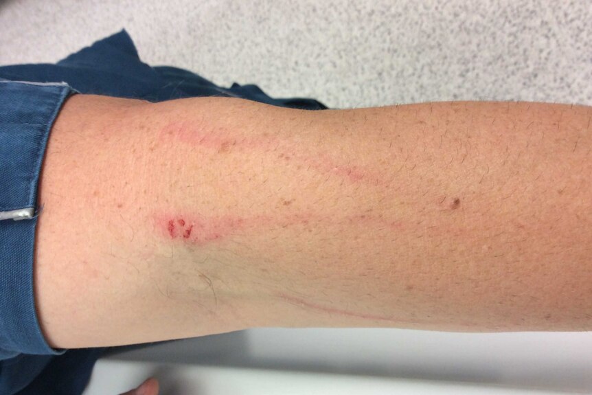 Scratches to the arm of an ambulance officer after he was attacked by a woman