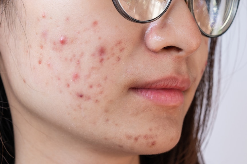 A young woman with acne covering her chin and cheeks