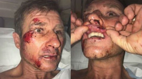 Two images side by side of a man's face. He is bloodied and bruised, in the right photo he is holding up his split lip.