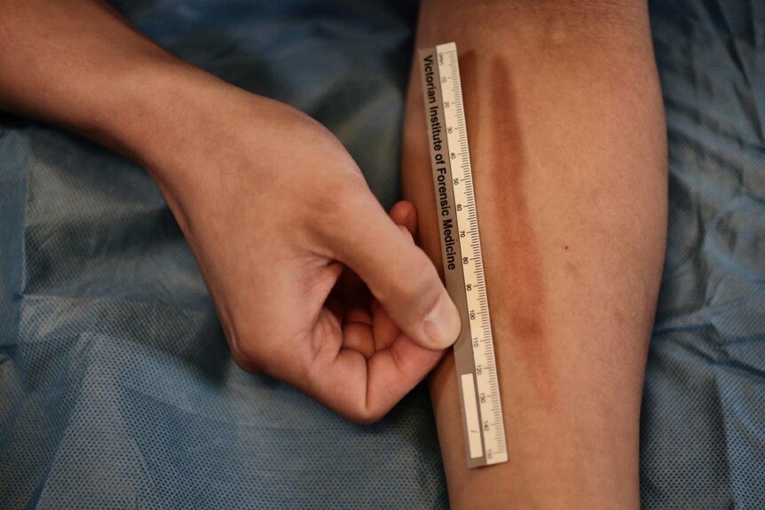 An arm injury is measured