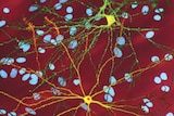 A graphic shows three images of single striatal neurons.