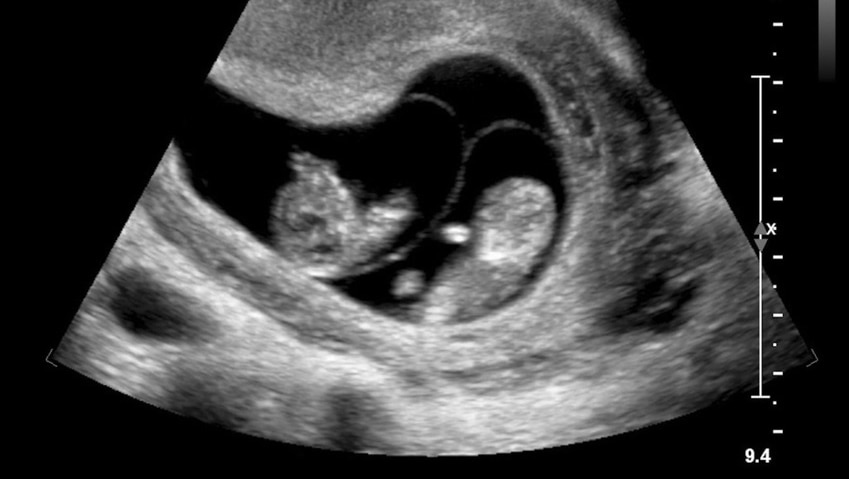 Twin in utero