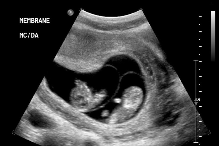 Monochorionic twins ultrasound