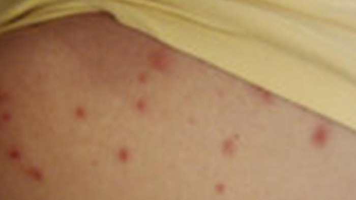 The measles rash can appear 2 to 7 days after the initial symptoms, which include a fever or cough.