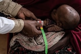 A doctor holds a measuring tape around a malnourished baby's arm. It measures in the red zone of the tape