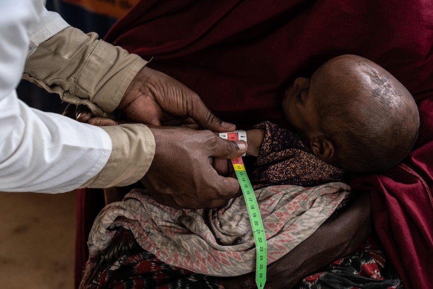A doctor holds a measuring tape around a malnourished baby's arm. It measures in the red zone of the tape