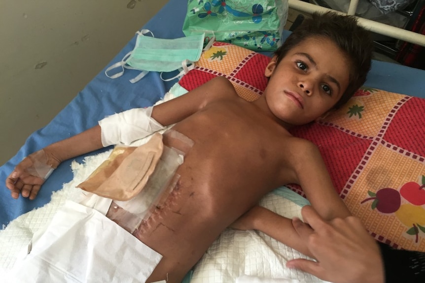 An 8-year-old boy lies on a bed with heavy bandages covering his abdomen.