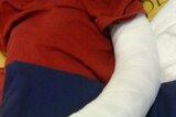 Broken arm of Iranian child