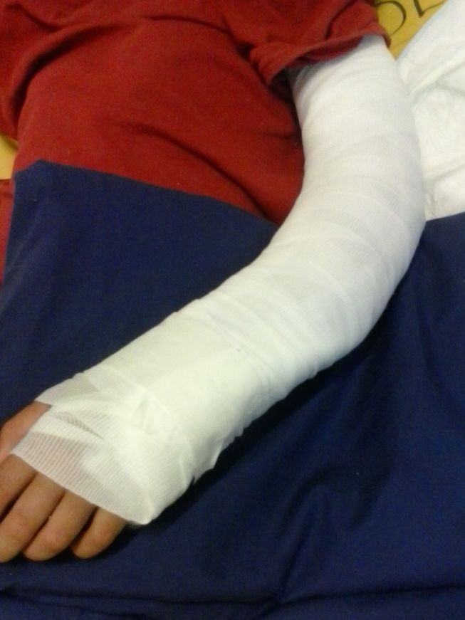 Broken arm of Iranian child