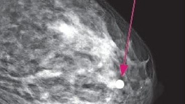 While in dense breasts, cancer can be harder to spot (Photos: BreastScreen SA).
