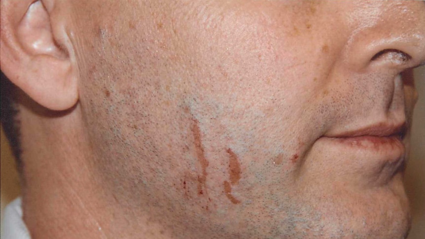 An image of scratches on Gerard Baden-Clay's face, which was presented as evidence on June 18, 2014.
