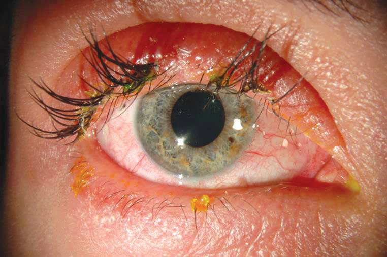 Eyelash Extensions Causing Serious Injuries Such As Chemical Burns And   9230889b693ae134fe38e7e069a7b630