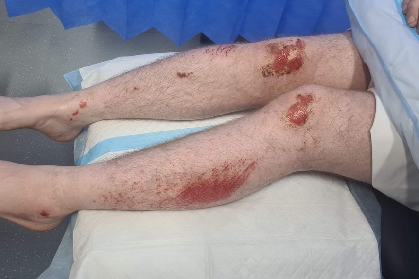 Two male legs with grazes on the knees and shins