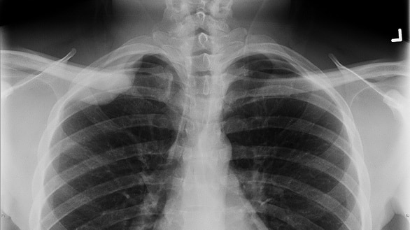 A chest X-ray image showing pleural-based density in upper-right lobe.