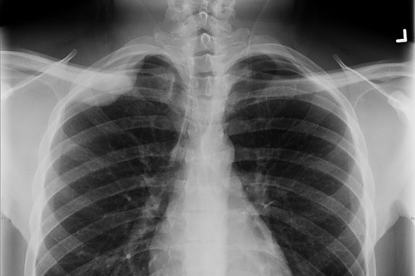 A chest X-ray image showing pleural-based density in upper-right lobe.