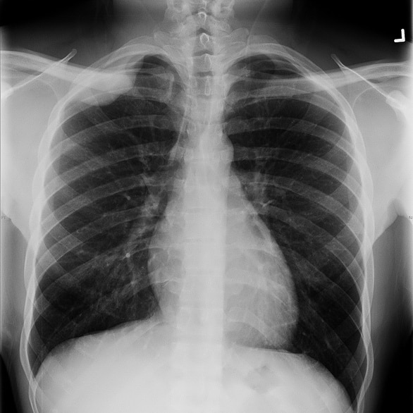 A chest X-ray image showing pleural-based density in upper-right lobe.