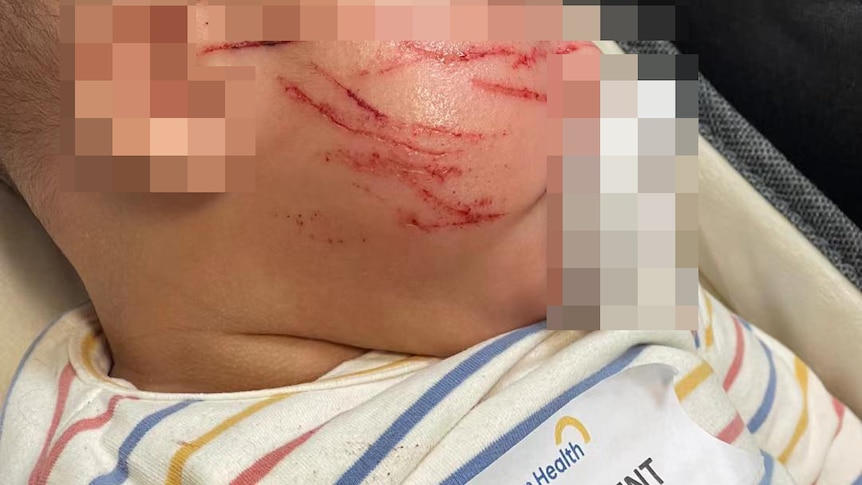墨尔本一位10周大的幼童在幼托机构被脸部严重抓伤。