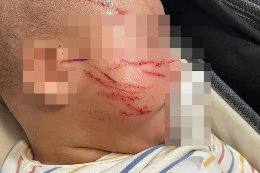 墨尔本一位10周大的幼童在幼托机构被脸部严重抓伤。