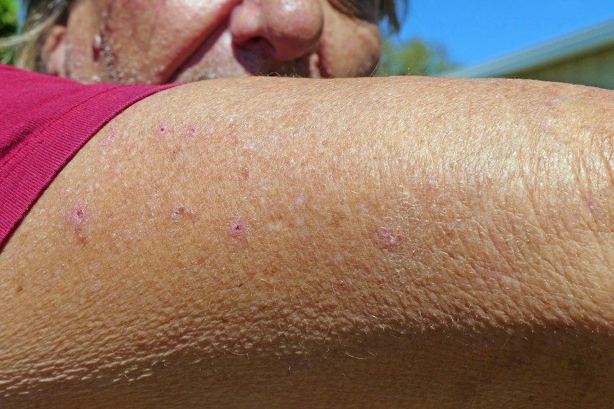 A close up of scars on Chris' arm