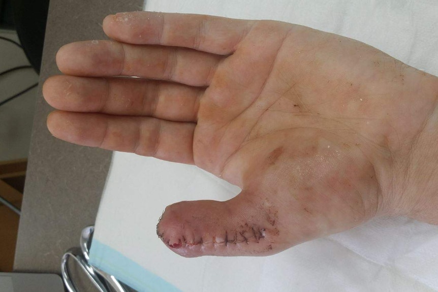 Marcel's thumb after the surgery