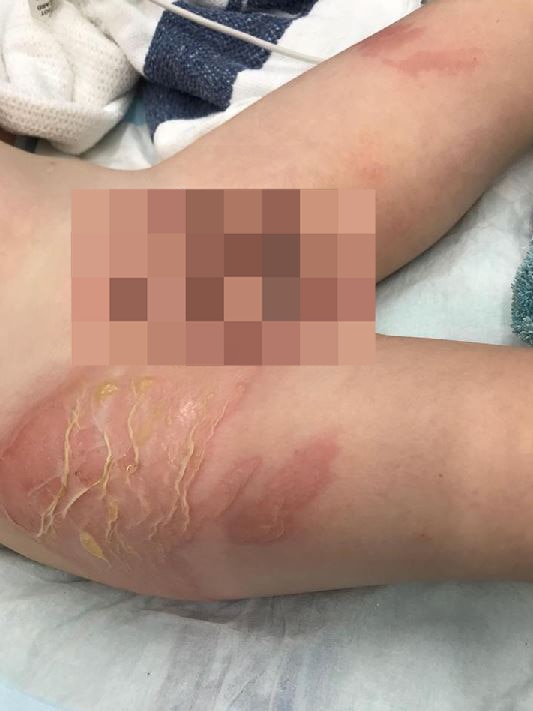 Qld mum's warning as out-of-date hot water bottle bursts, scalding