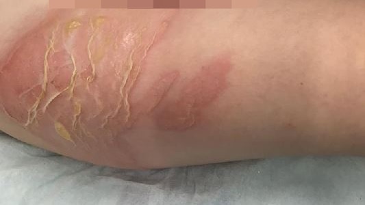 A young child's upper thigh and groin area with red scalding and peeling skin after a hot water bottle burn.