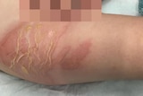 A young child's upper thigh and groin area with red scalding and peeling skin after a hot water bottle burn.