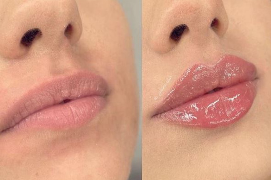Before and after shot of lips pre- and post- lip filler.