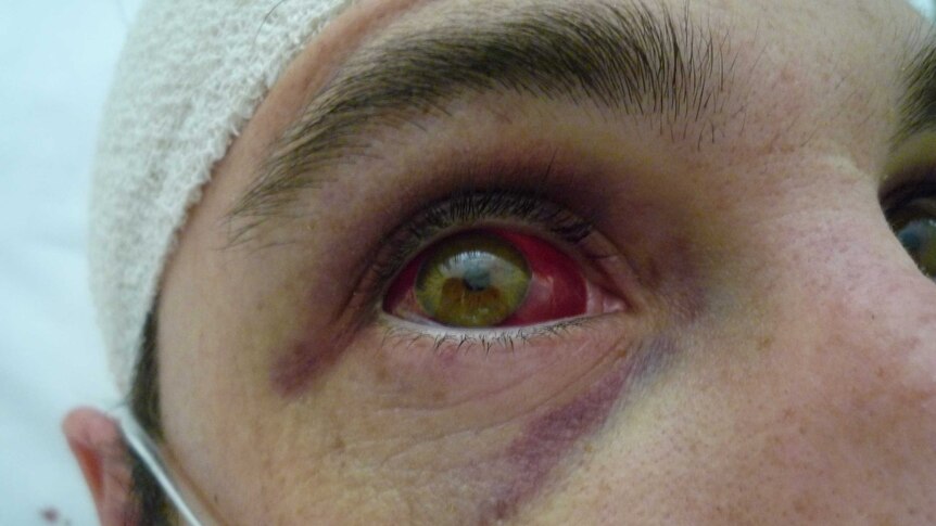 A close-up of the side of a face showing bruising around the eye and blood in the white of the eye.