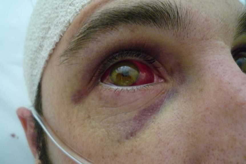 A close-up of the side of a face showing bruising around the eye and blood in the white of the eye.