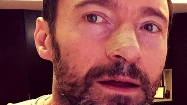 Hugh Jackman posts on Instagram after having a skin cancer removed.