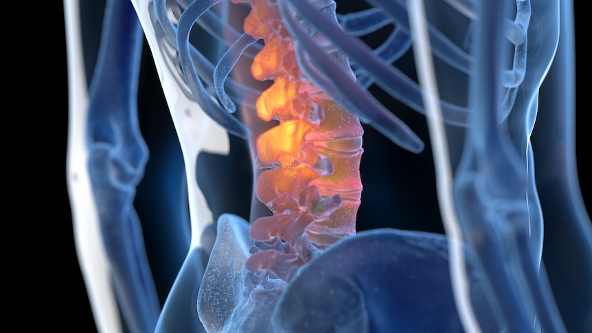 Chronic low back pain—do spinal cord stimulators work? - ABC listen