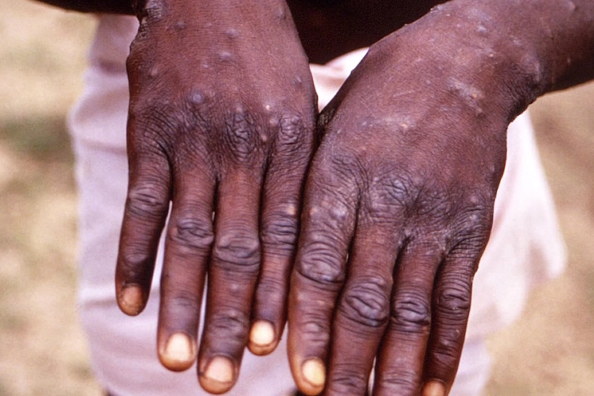 two hands infected with monkeypox virus showing signs of blistering