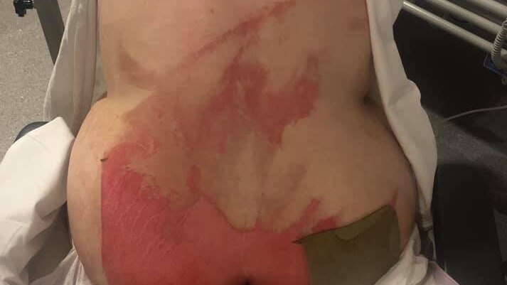 Woman sits with her back turned in a hospital gown, displaying severe burns to lower back and bottom