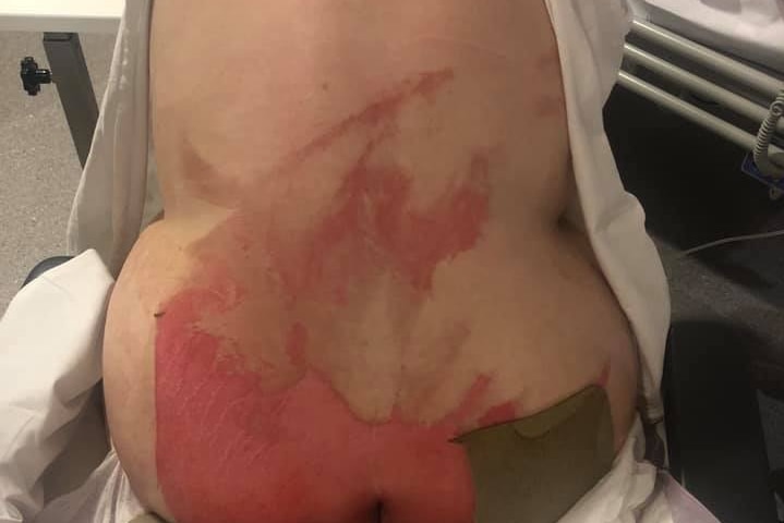 Woman sits with her back turned in a hospital gown, displaying severe burns to lower back and bottom