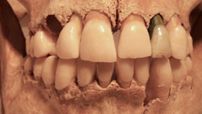 A combination of handout pictures showing close-up shots of the teeth of skulls from a Roman archaeological site in Britain, October 23, 2014