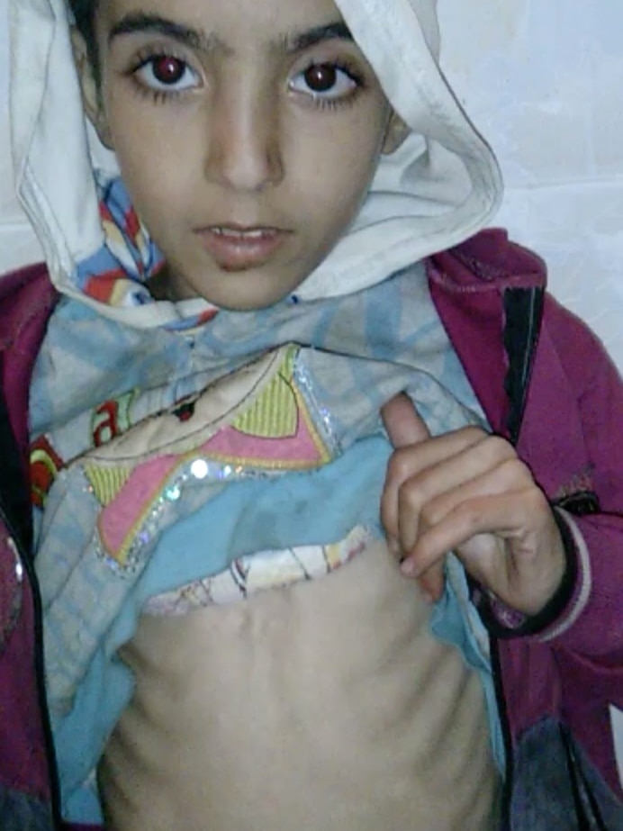 An emaciated female child shows her exposed ribcage in Madaya, Syria.