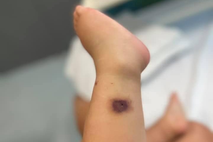 a small purple bite on a two year old's leg