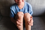 A young boy in a blue t-shirt smiles, holding his knees, one of which has a Band-Aid.