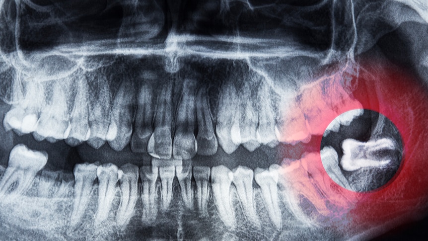 Xray with wisdom tooth highlighted