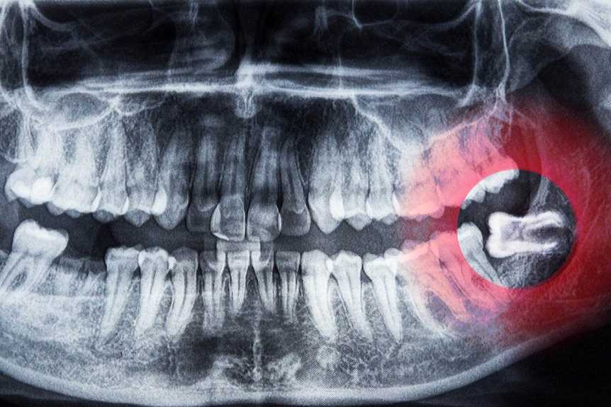 X-ray with wisdom tooth highlighted