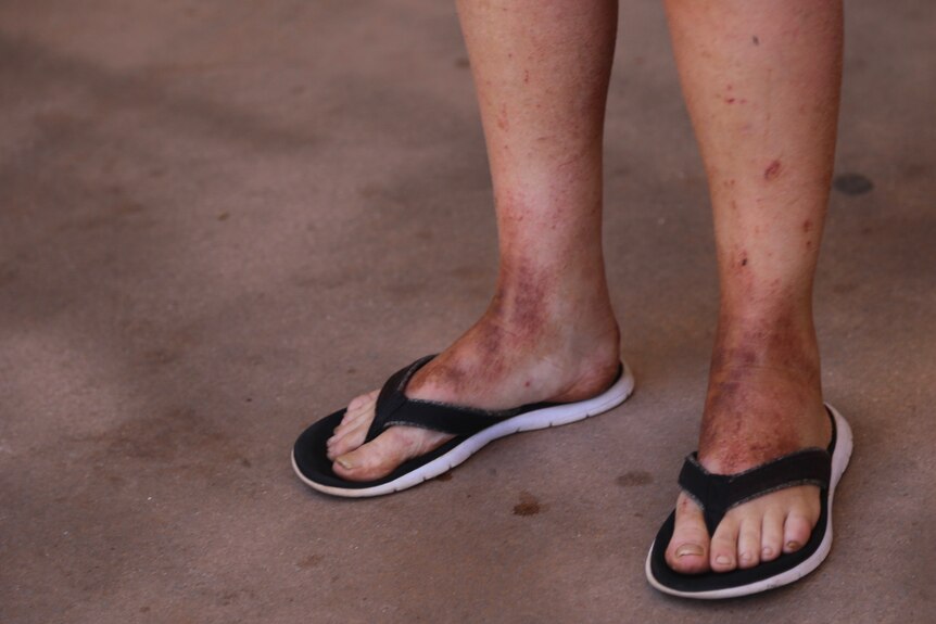 Tamra McBeath-Riley is wearing thongs, her feet look sore and scratched