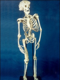 the bones of Joseph Merrick