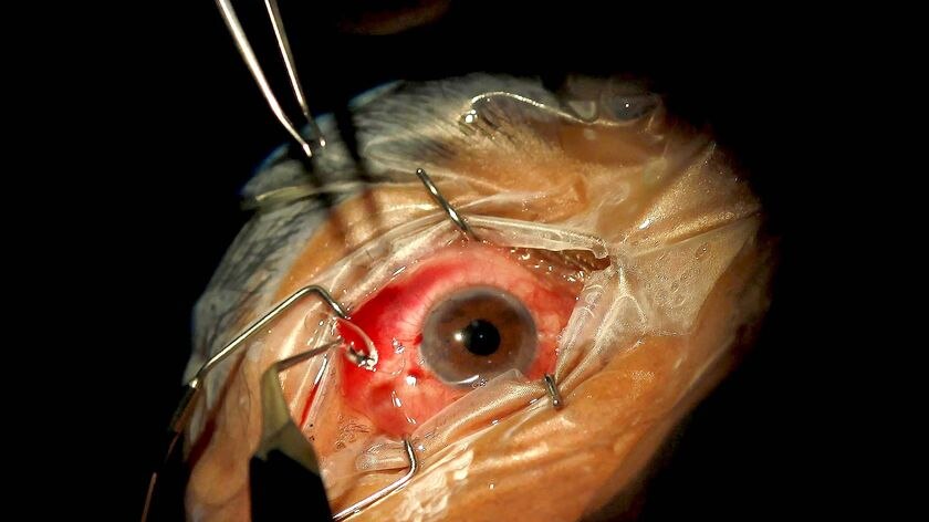 A doctor attaches a new lens onto an eye during cataract surgery
