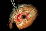 cataract surgery - file photo